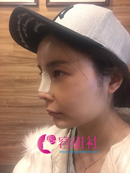 韩国碧夏整形医院额头自体脂肪填充+肋软骨隆鼻手术后第3天