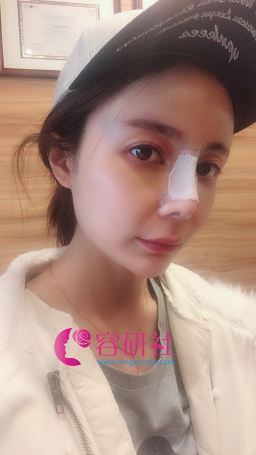 韩国碧夏整形医院额头自体脂肪填充+肋软骨隆鼻手术后第4天