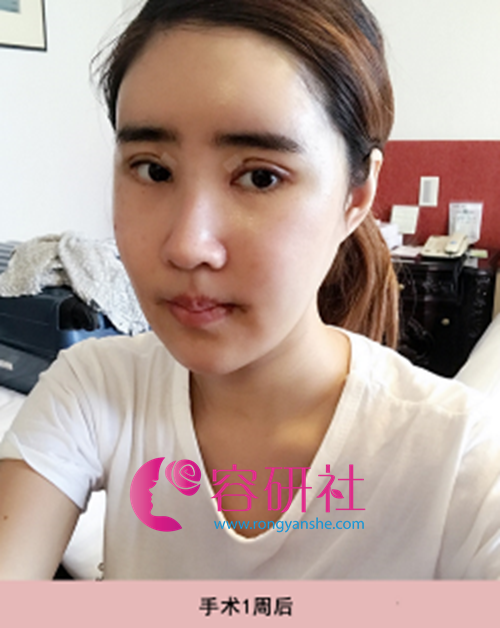 韩国ID整形医院轮廓+鼻综合手术后第7天
