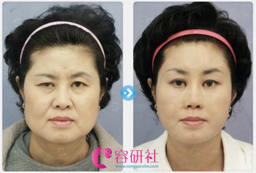 面部埋线提升手术前后效果对比