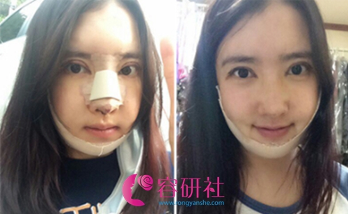 韩国灰姑娘整形医院面部综合提升术后第7天