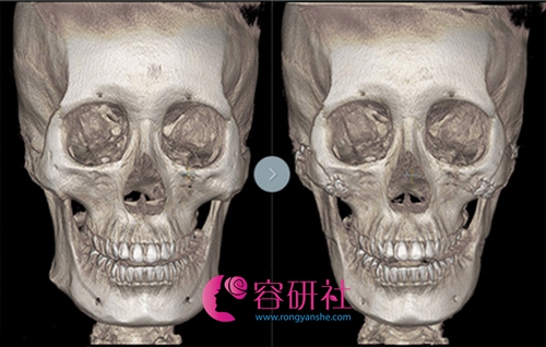 下颌角手术前后ct图对比