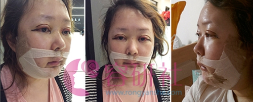 韩国灰姑娘整形医院轮廓手术术后第一天
