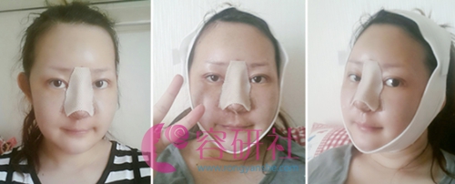 韩国灰姑娘整形医院鼻综合整形术后第1天
