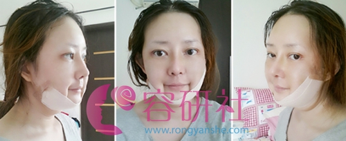 韩国灰姑娘整形医院鼻综合整形术后第7天