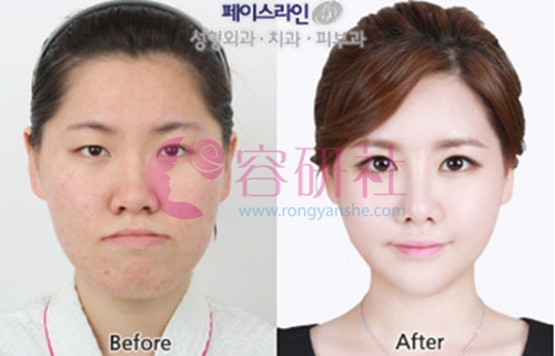 韩国face-line整形医院双鄂手术案例