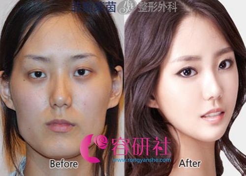 韩国face-line整形医院李真秀院长面部轮廓手术案例