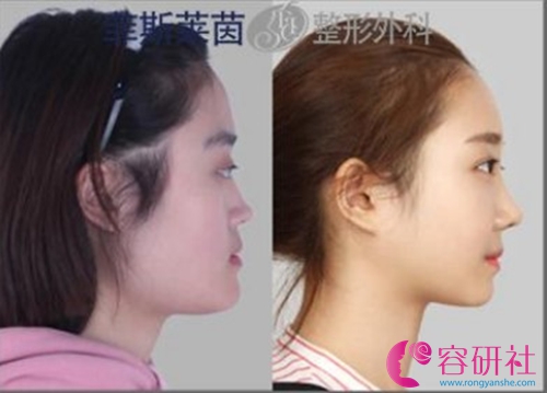 韩国face-line隆鼻手术真人案例前后对比照
