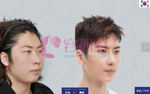 韩国ID整形医院面部轮廓案例