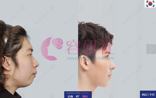 韩国ID整形医院面部轮廓案例