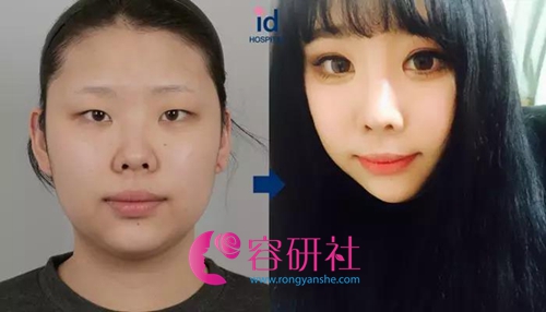 韩国ID整形医院芭比鼻整形案例
