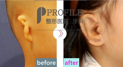 韩国profile整形外科郑在皓耳廓再造术案例