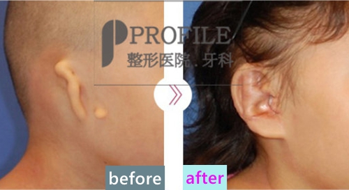 韩国profile整形外科郑在皓耳廓再造手术案例