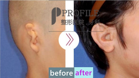 韩国profile整形外科郑在皓小耳畸形矫正前后对比图