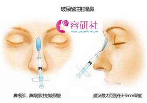 玻尿酸隆鼻注射方式