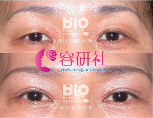 bio整形医院双眼皮手术案例