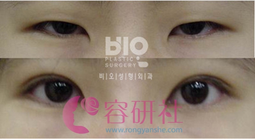bio整形医院双眼皮手术日记
