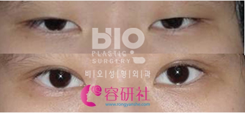 韩国bio整形医院双眼欧手术案例