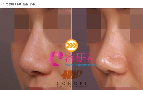 韩国高诺鼻coconopi整形医院鼻修复手术日记