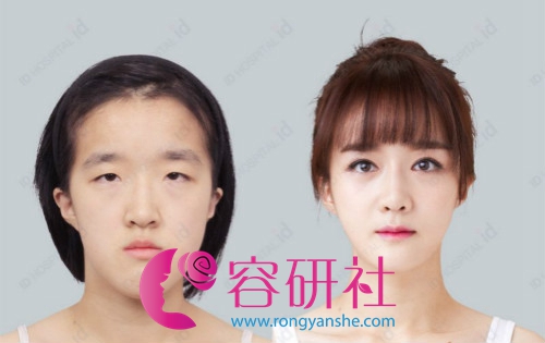 韩国ID整形医院面部轮廓手术案例