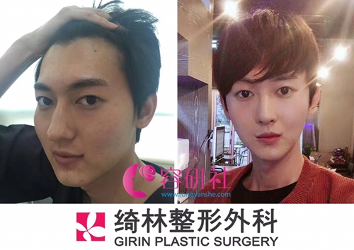 韩国绮林整形外科面部轮廓手术案例