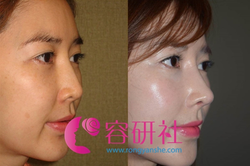 韩国可安美整形医院鼻综合手术案例