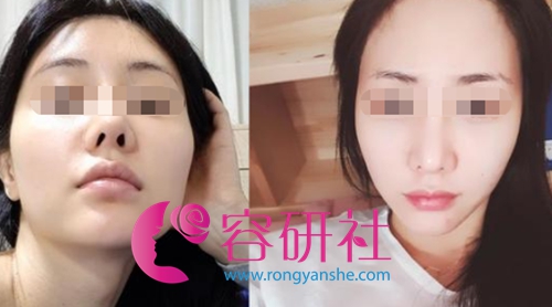 韩国美迪莹整形医院面部轮廓手术前后对比