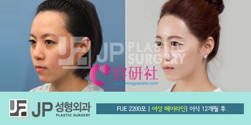 韩国JP毛发移植中心毛发移植手术案例