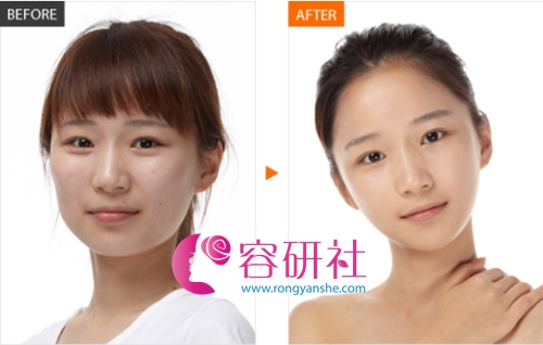 韩国巴诺巴奇整形医院面部轮廓手术案例