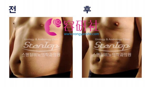 韩国世檀塔脂肪雕刻腹肌前后效果对比