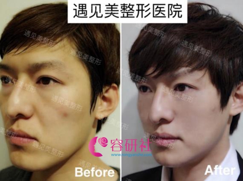 韩国遇见美整形整形外科面部轮廓手术案例