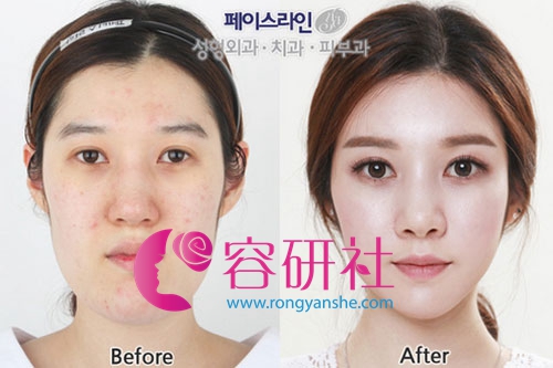 韩国菲斯莱茵整形医院面部轮廓手术案例