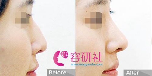 韩国OLIVE整形医院鼻综合手术案例
