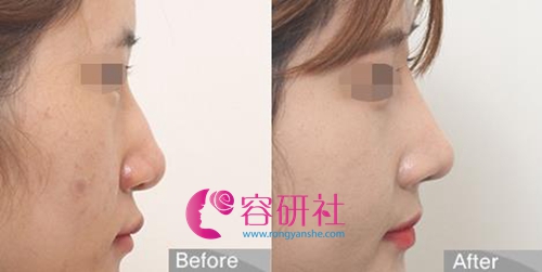 韩国OLIVE整形医院鼻综合手术
