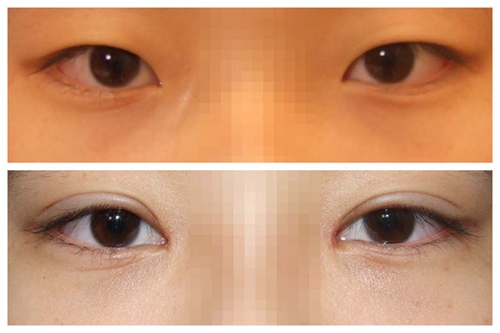 双眼皮手术案例
