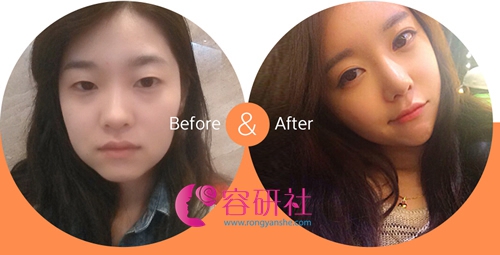 韩国爱我整形外科面部轮廓手术案例