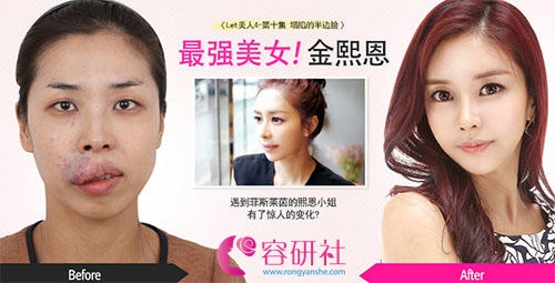 韩国faceline整形外科面部轮廓手术案例
