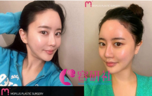 韩国moplus毛发移植中心非切开式发际线移植手术案例