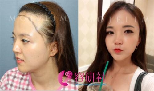 韩国毛杰琳毛发移植中心非切开式发际线移植手术