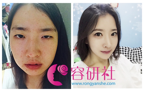 韩国灰姑娘整形医院的面部综合整形术前术后对比照