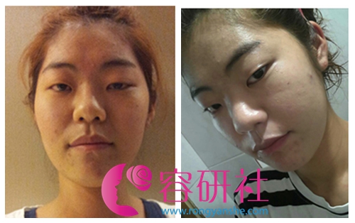 韩国新帝瑞娜医院眼部+鼻部+脂肪填充术前