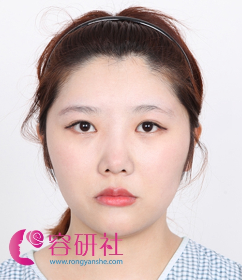 韩国faceline医院的颧骨缩小术+眼鼻综合术前
