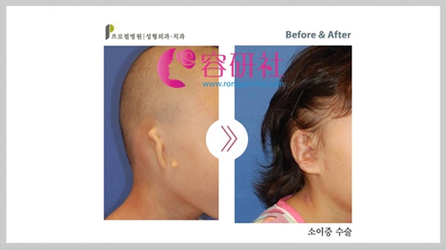 韩国普露菲耳（profile）整形医院耳畸形矫正日记