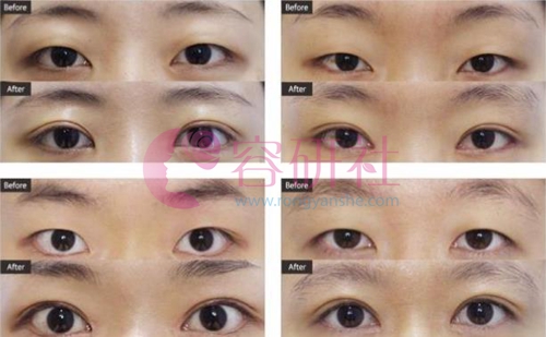 韩国ST整形外科双眼皮手术日记