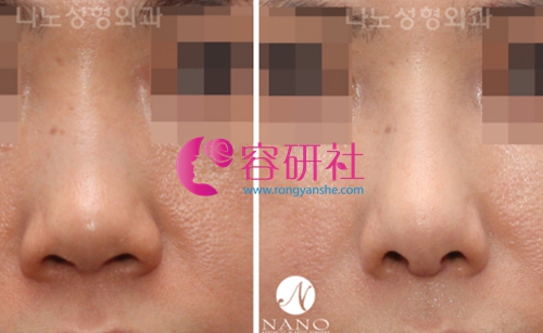 韩国NANO整形外科鼻修复手术案例