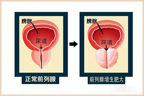 韩国世檀塔男科医院李昌敏讲解正常前列腺与前列腺增生肥大的区别