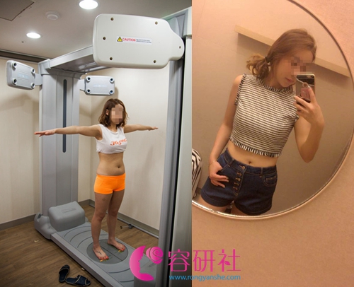 韩国365mc整形外科腰腹吸脂案例
