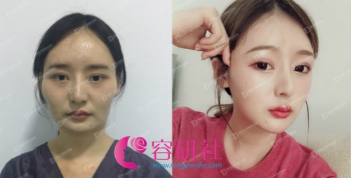 韩国女神整形外科25°颧骨内推手术日记