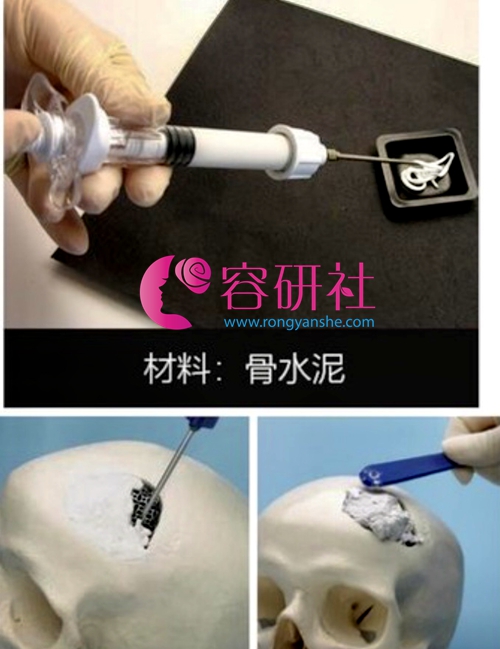 韩国雕刻整形外科医院骨水泥填充后脑勺手术方法