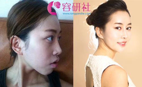韩国普露菲耳（profile）整形医院女士轮廓手术案例